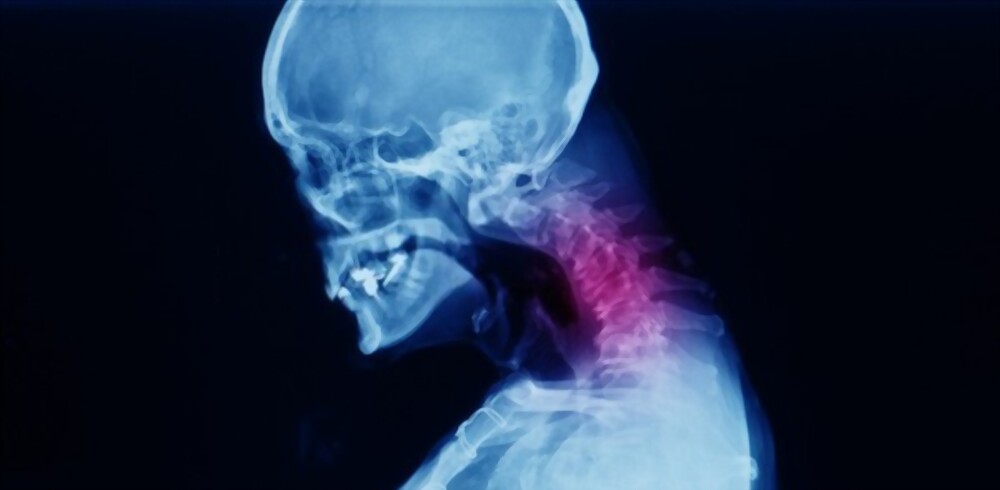 Neck Fusion Explained